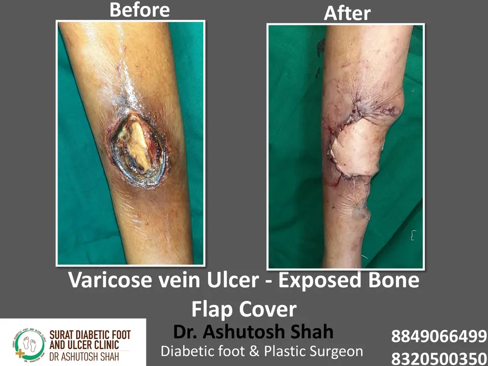 Varicose veins and Ulcers.pptx-12.webp